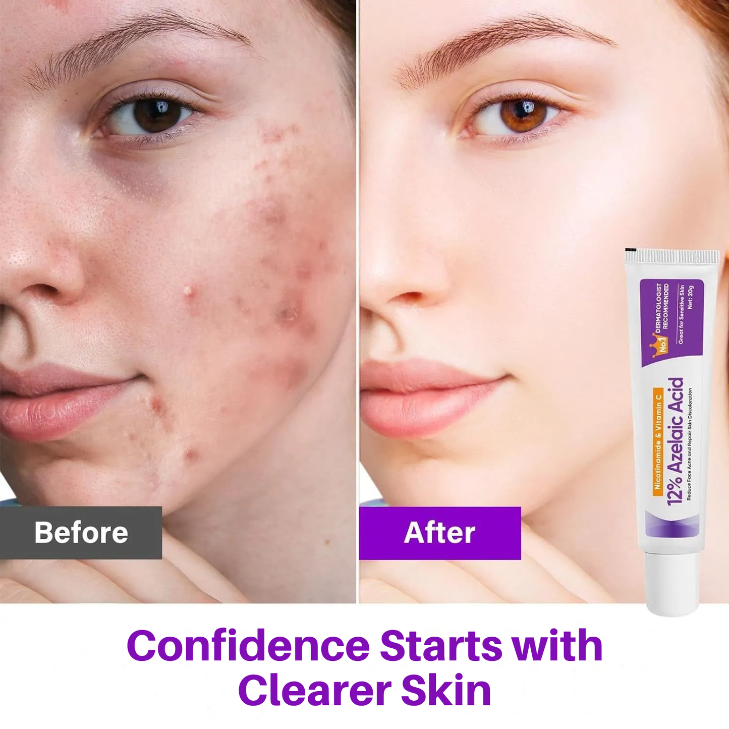 Azelaic Acid 12% Dark Spot Correcting Gel with Vitamin C & Niacinamide - Brightening Treatment for Even Skin Tone