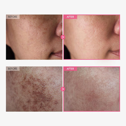 Mzansi Radiance Azelaic Acid Gel